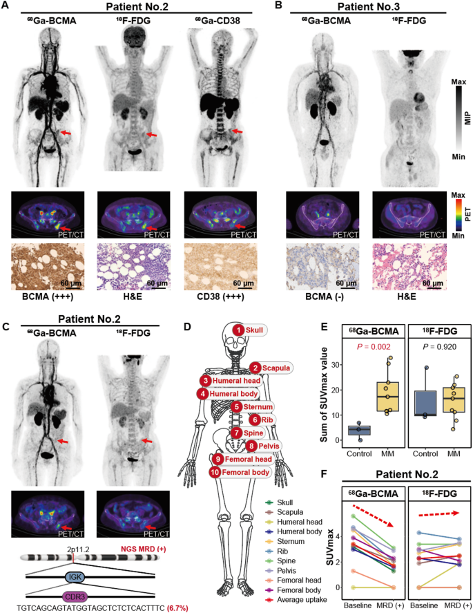 B-cell maturation antigen targeted PET/CT imaging in multiple myeloma ...