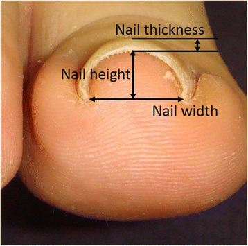 Types of pincer nails cited from ref 5  Download Scientific Diagram