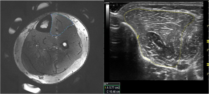 Leg Muscle Cross Sectional Area Measured By Ultrasound Is Highly Correlated With Mri Journal Of Foot And Ankle Research Full Text