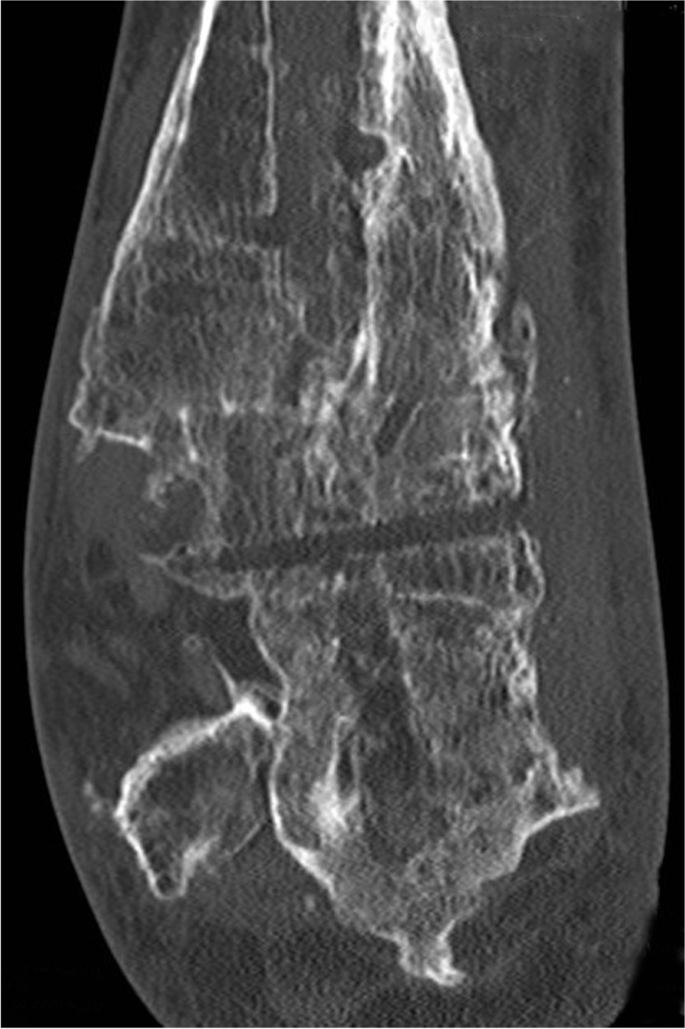 Extra-Caliber (carbon fiber) Radiolucent Tibia/Ankle System