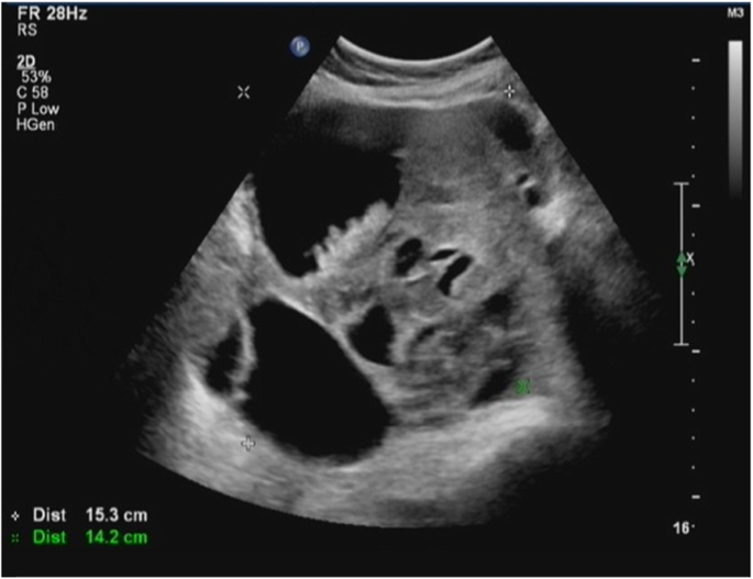 ovarian cancer during pregnancy)