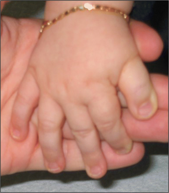 Rubinstein–Taybi syndrome - Wikipedia