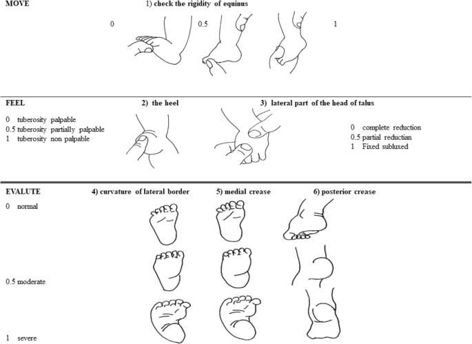 What A Paediatrician Should Know About Congenital Clubfoot Italian Journal Of Pediatrics Full Text