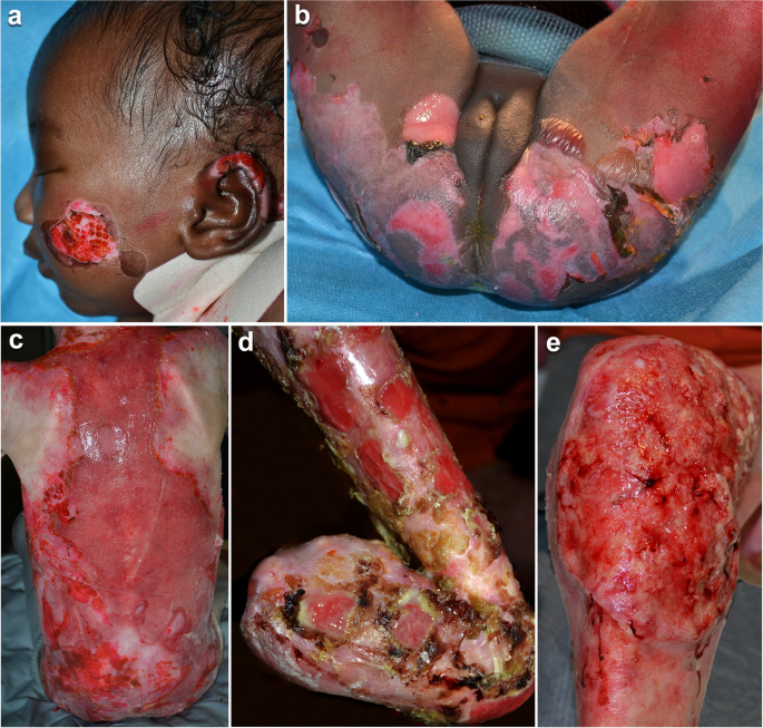 Multidisciplinary care for patients with epidermolysis bullosa from birth  to adolescence: experience of one Italian reference center | Italian  Journal of Pediatrics | Full Text