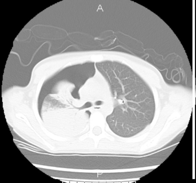 Acetylcysteine and budesonide for the treatment of refractory Mycoplasma  pneumoniae pneumonia in children: a clinical observation | Italian Journal  of Pediatrics | Springer Nature Link