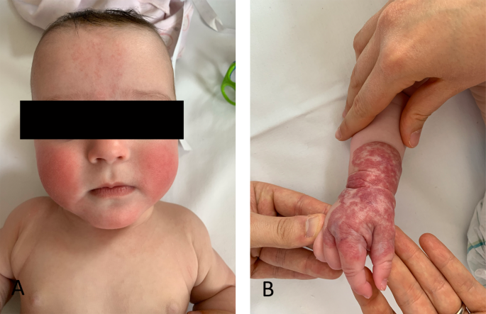Beckwith-Wiedemann syndrome and twinning: case report and brief review of  literature | Italian Journal of Pediatrics | Full Text