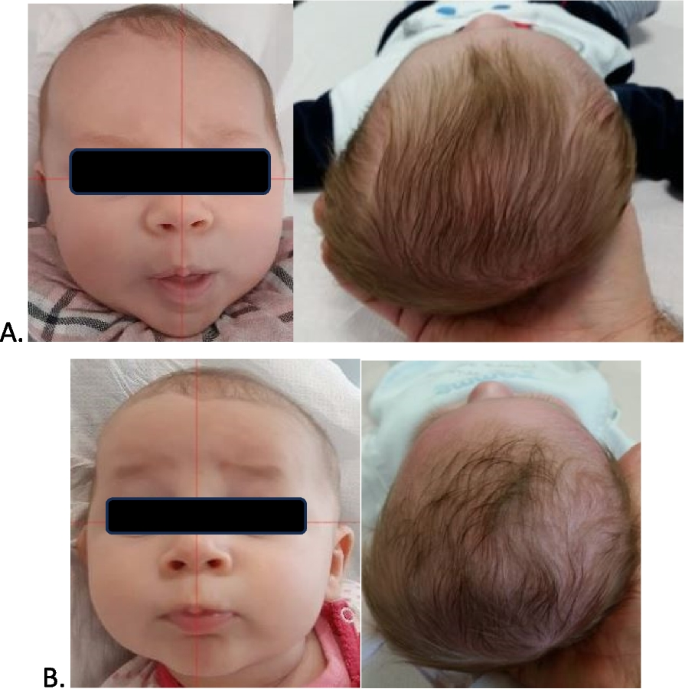 Positional plagiocephaly: results of the osteopathic treatment of 424  infants. An observational retrospective cohort study | Italian Journal of  Pediatrics | Full Text