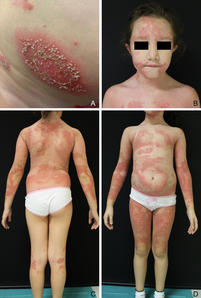 ghk-cu psoriasis GHK-Cu: The Peptide That Transforms Skin and Tissue Health – Calibrate  Hydration main image 0