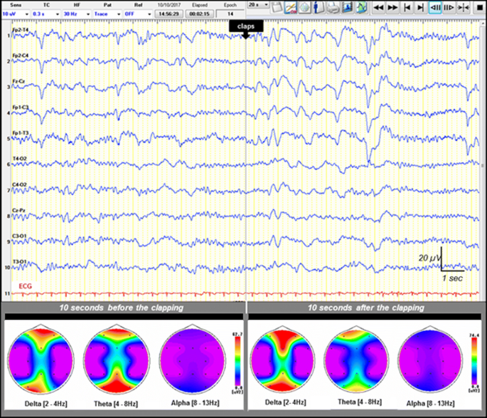 eeg medical abbreviation eeg medical abbreviation