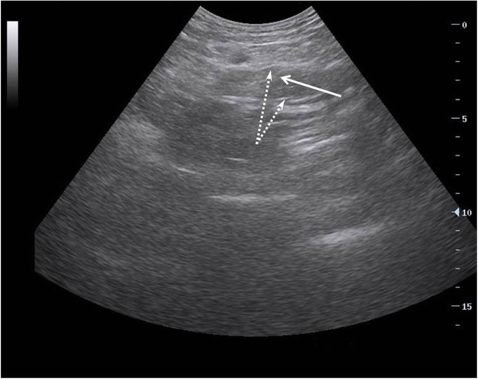 Portable Ultrasound Machines Being Misused For Sex Determination In Haryana