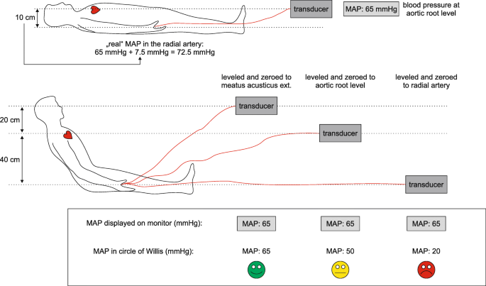 How to measure blood pressure using an arterial catheter: a systematic  5-step approach | Critical Care | Full Text