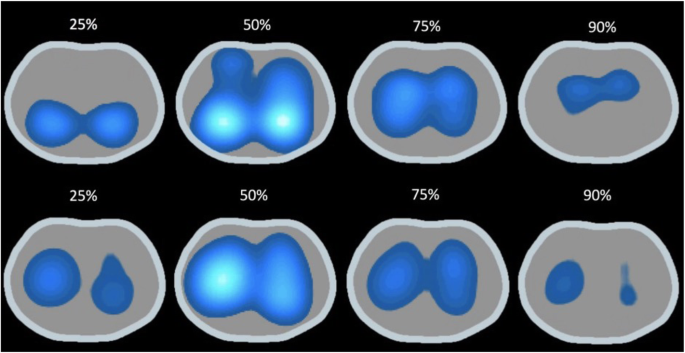 A physiological approach to understand the role of respiratory effort in  the progression of lung injury in SARS-CoV-2 infection | Critical Care |  Full Text