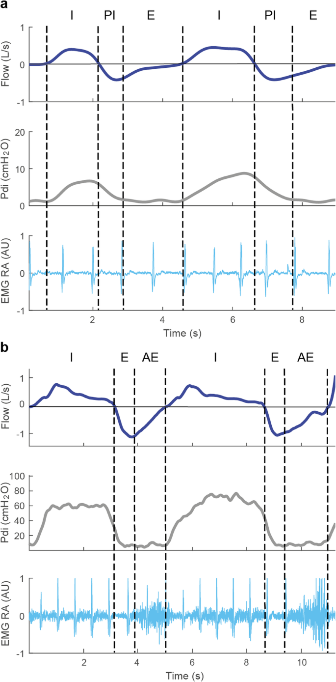 Physiology of the Respiratory Drive in ICU Patients: Implications for  Diagnosis and Treatment | Critical Care | Full Text