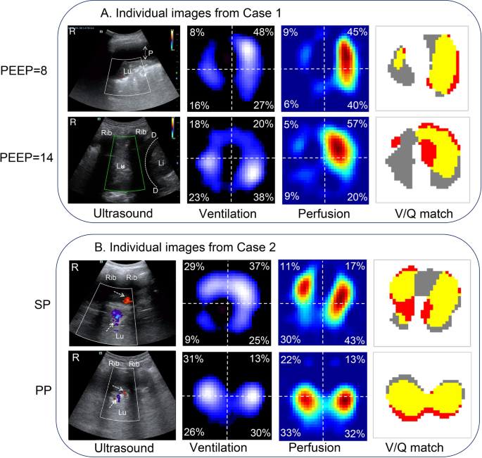Two regional ventilation–perfusion patterns of lung consolidation assessed  by electrical impedance tomography and ultrasound | Critical Care | Full  Text
