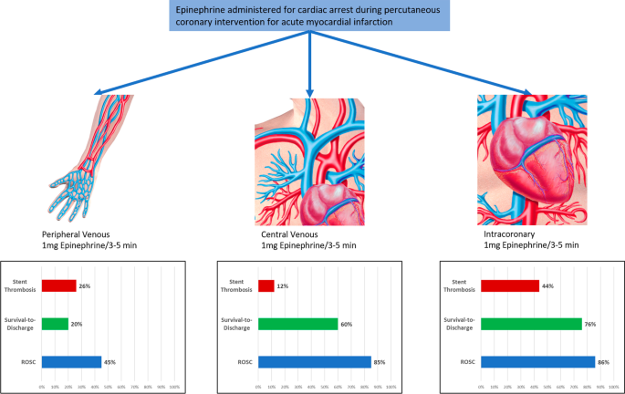 A prospective observational study on impact of epinephrine administration  route on acute myocardial infarction patients with cardiac arrest in the  catheterization laboratory (iCPR study) | Critical Care | Full Text