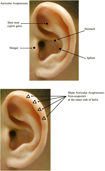 The combination effects of body acupuncture and auricular acupressure  compared to sham acupuncture for body weight control: study protocol for a  randomized controlled trial | Trials | Full Text