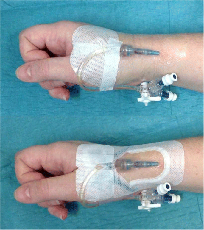 A novel integrated dressing to secure peripheral intravenous catheters in  an adult acute hospital: a pilot randomised controlled trial | Trials |  Full Text