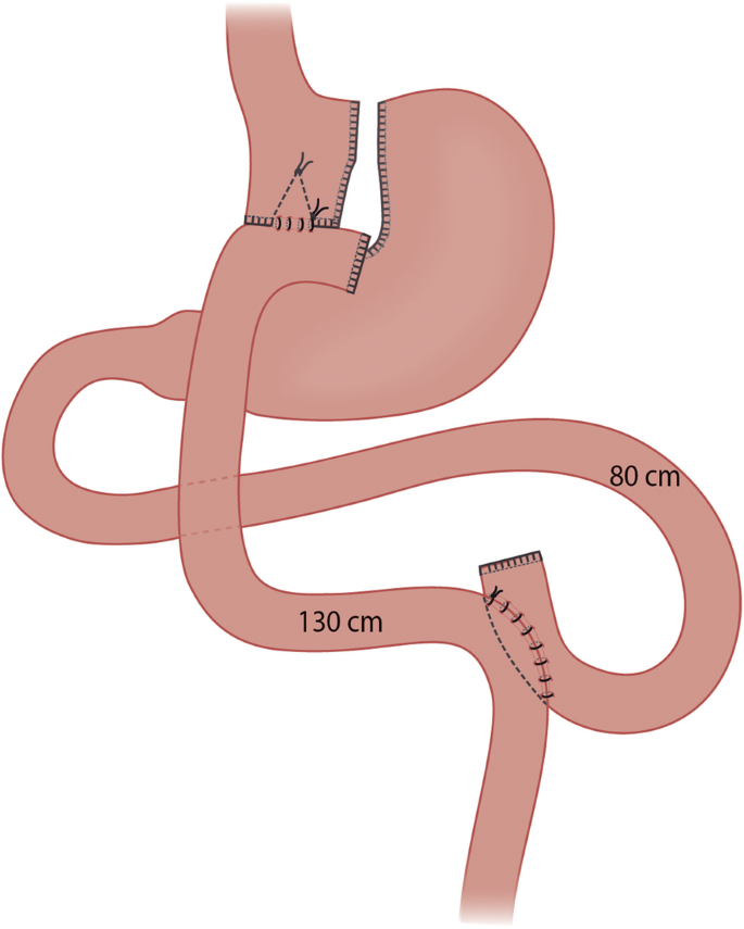 Prospective Randomized Controlled Trial Comparing The Efficacy And Safety Of Roux En Y Gastric Bypass And One Anastomosis Gastric Bypass The Rysa Trial Trial Protocol And Interim Analysis Trials Full Text - bypassed roblox ids 2018 6 28 2018