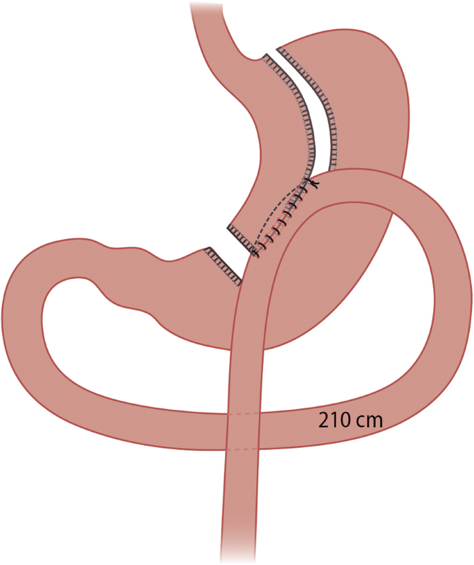 Prospective Randomized Controlled Trial Comparing The Efficacy And Safety Of Roux En Y Gastric Bypass And One Anastomosis Gastric Bypass The Rysa Trial Trial Protocol And Interim Analysis Trials Full Text - bypassed roblox ids 2018 6 28 2018