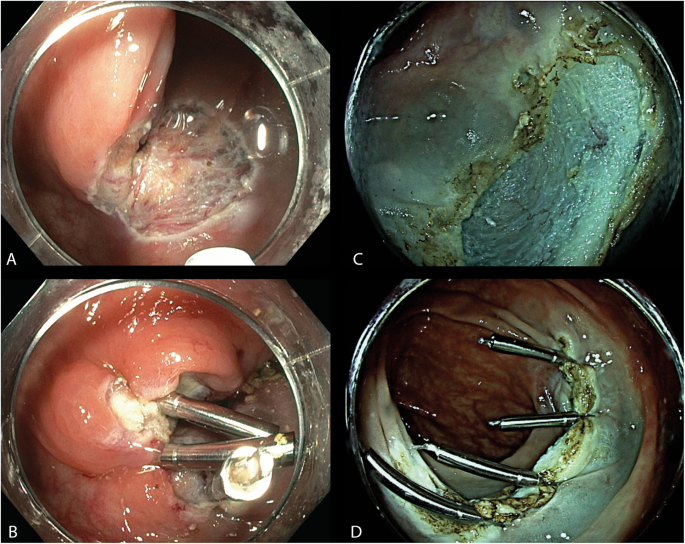 Clip placement to prevent delayed bleeding after colonic endoscopic mucosal  resection (CLIPPER): study protocol for a randomized controlled trial |  Trials | Full Text