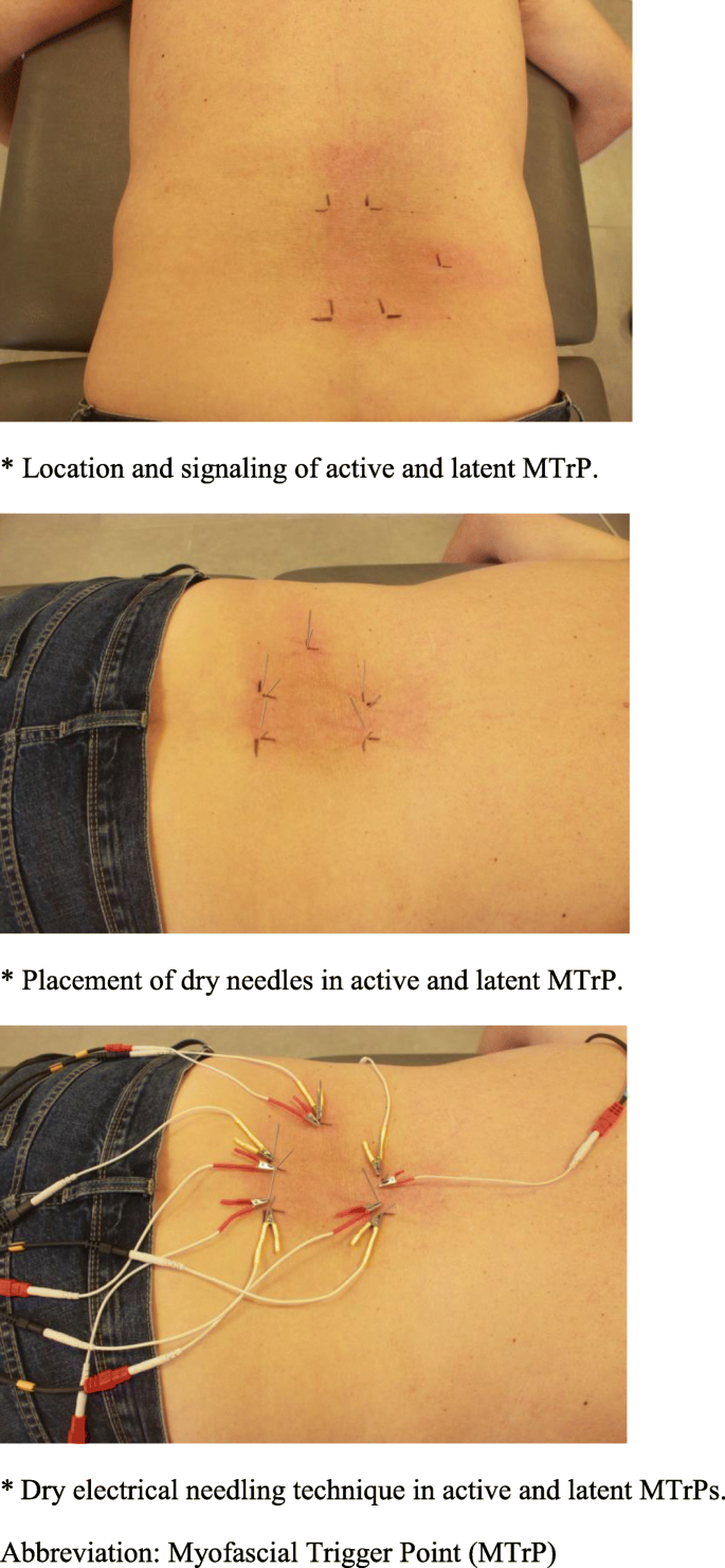 Understanding the Low Back Pain Trigger Points