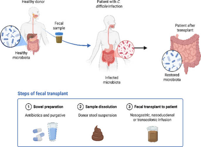 Harnessing the power of faecal microbiota transplantation: optimizing ...