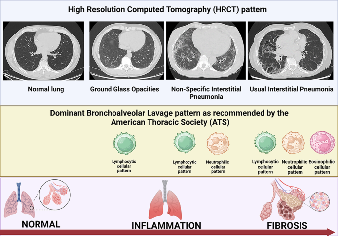 High-Resolution Computed Tomography (HRCT) is a specialized computed tomography (CT) technique designed to enhance image resolution, particularly for assessing lung parenchyma and certain middle ear diseases[1]. HRCT is more precise than standard chest X-rays in diagnosing and monitoring lung tissue and airway diseases[3]. By using specific imaging parameters, HRCT provides detailed pictures of the lungs, allowing healthcare providers to diagnose and monitor various conditions affecting the small airways, air sacs (alveoli), and surrounding tissues[2].