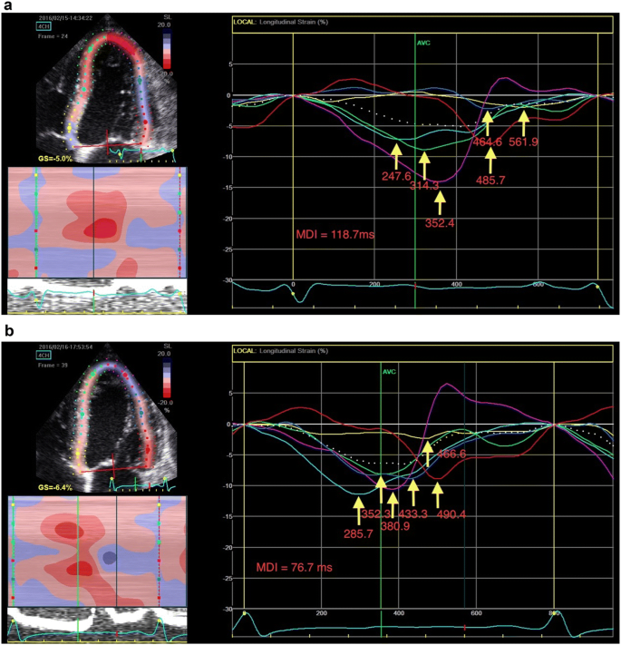 Global Longitudinal Strain and Cardiac Events in Patients With