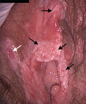 Hpv genital ulcers. Detoxifierea oshawa