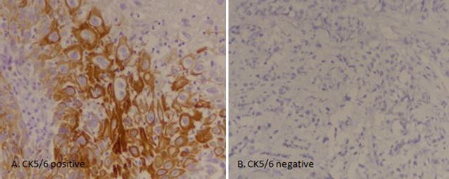 Cytokeratin 5 6 Expression In Bladder Cancer Association With Clinicopathologic Parameters And Prognosis Bmc Research Notes Full Text