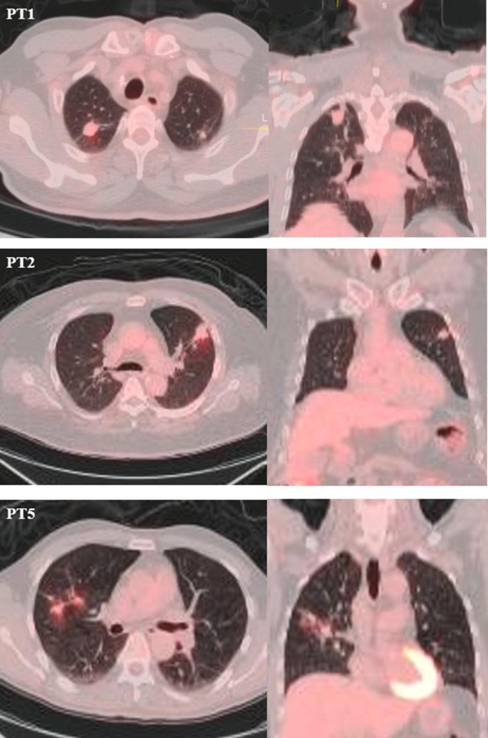 FDG-PET/CT activity leads to the diagnosis of unsuspected TB: a  retrospective study | BMC Research Notes | Full Text