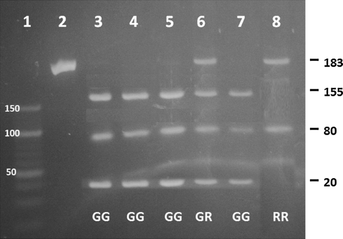 The role of insulin receptor substrate 1 gene polymorphism 