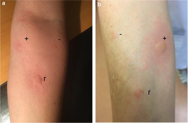 Anaphylactic shock following castor bean contact: a case report | Allergy,  Asthma & Clinical Immunology | Full Text