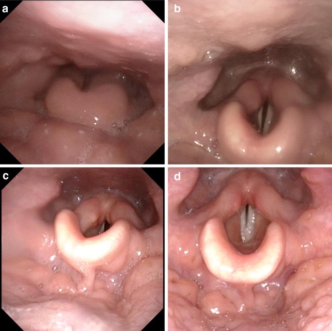 lingual tonsil cancer symptoms