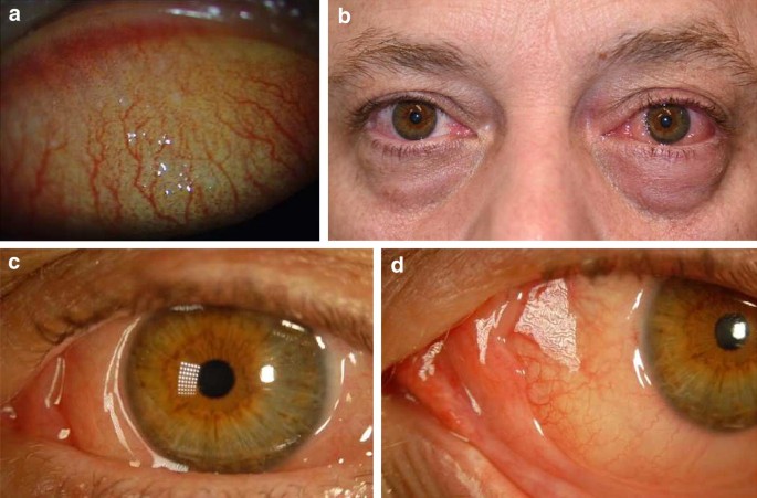 A contemporary look at allergic conjunctivitis | Allergy, Asthma & Clinical  Immunology | Full Text