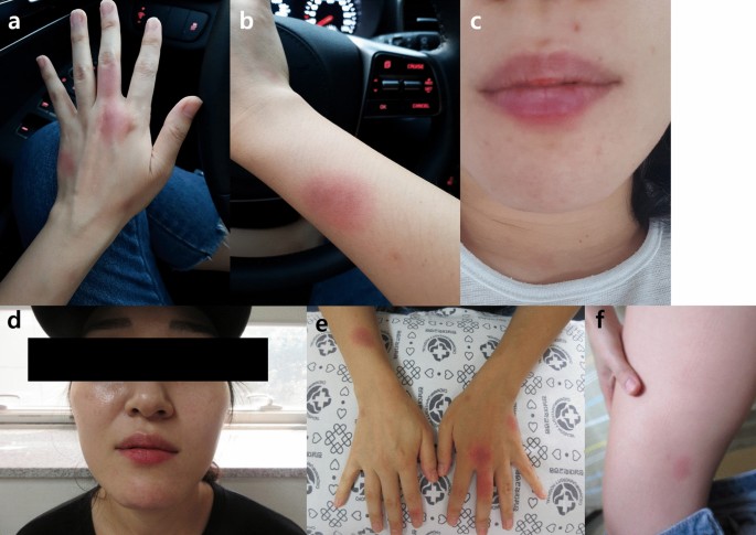 Fixed Drug Eruption And Anaphylaxis Induced Concurrently By Erdosteine A Case Report Allergy Asthma Clinical Immunology Full Text