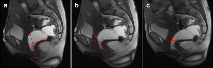 Dynamic Magnetic Resonance Imaging Of The Female Pelvic Floor A Pictorial Review Insights Into Imaging Full Text