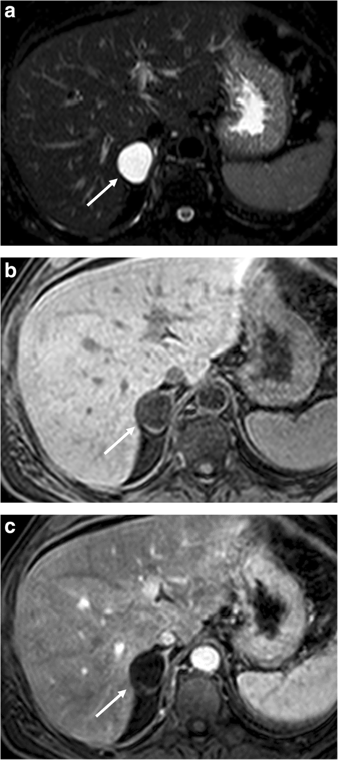 Imaging features of adrenal masses | Insights into Imaging | Full Text