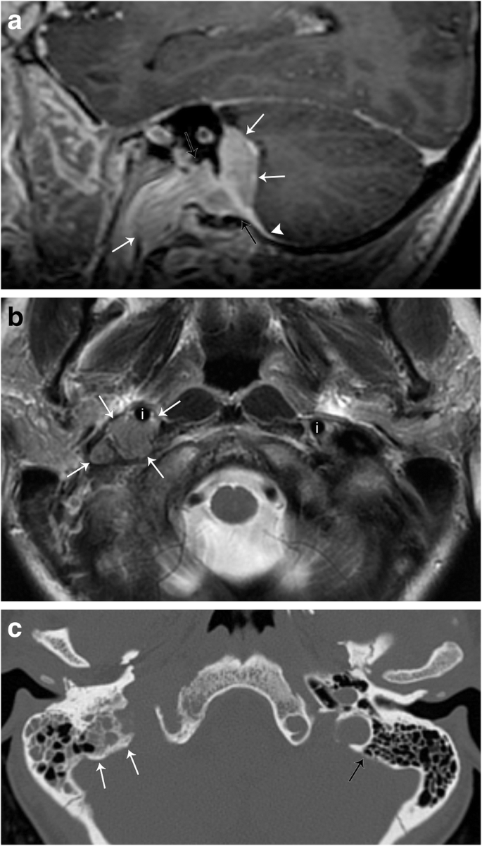 carotid sheath