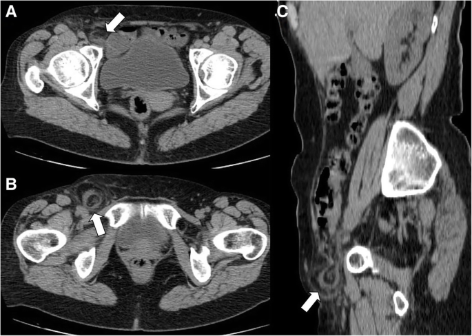 CT imaging findings of epiploic appendagitis: an unusual cause of abdominal pain | Insights into Imaging | Full Text CT imaging findings of epiploic appendagitis: an unusual cause of abdominal pain | Insights into Imaging | Full Text