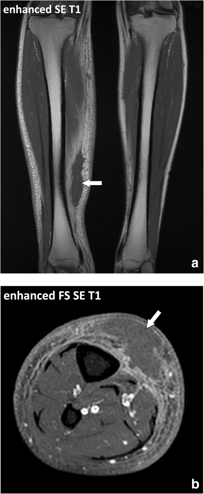 Fasciae of the musculoskeletal system: MRI findings in trauma, infection  and neoplastic diseases | Insights into Imaging | Full Text