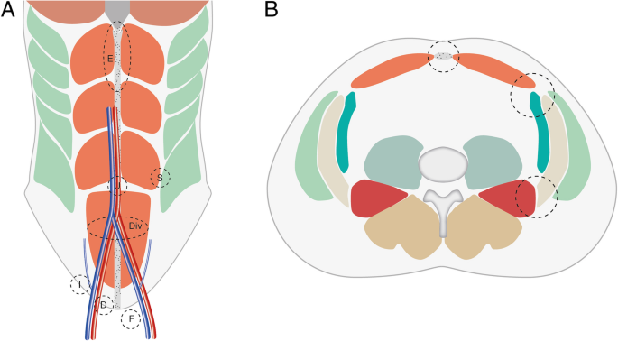 Muscle hernia in a 40-year-old man with a tender palpable mass at