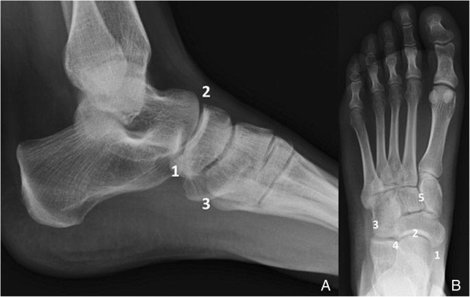 Anatomical variation in the ankle and foot: from incidental finding to  inductor of pathology. Part II: midfooot and forefoot | Insights into  Imaging | Full Text