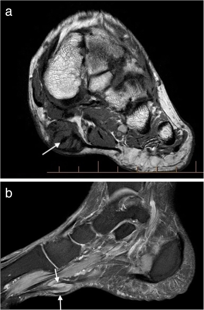 Mri Imaging Of Soft Tissue Tumours Of The Foot And Ankle Springerlink