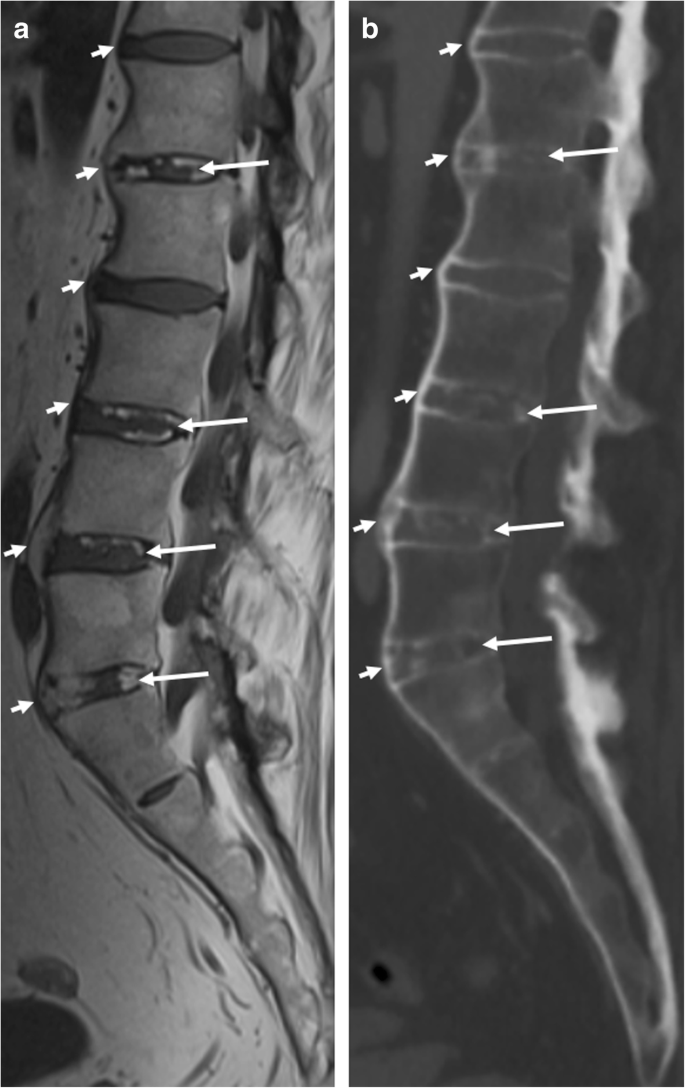 Sternum - WikiMSK