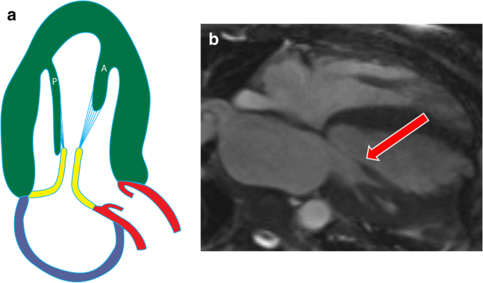 Magnetic resonance imaging of the papillary muscles of the left ventricle:  normal anatomy, variants, and abnormalities | Insights into Imaging | Full  Text