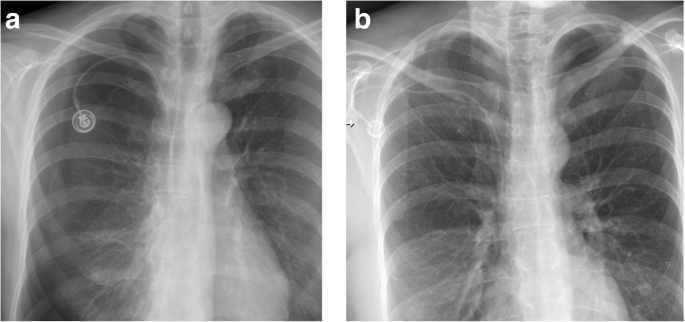 Complications of central venous port systems: a pictorial review | Insights  into Imaging | Full Text