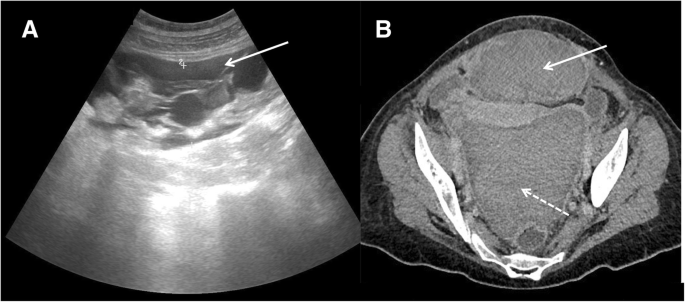 Imaging findings of cesarean delivery complications: cesarean scar disease  and much more | Insights into Imaging | Full Text