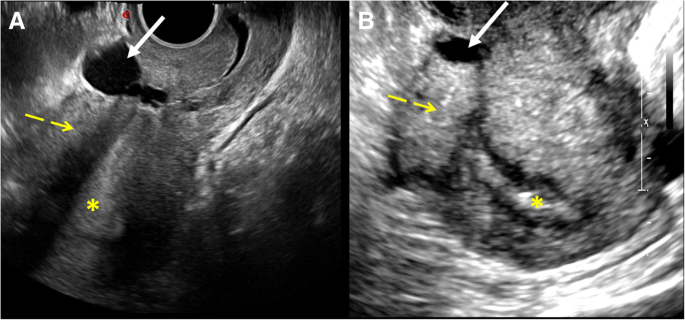 Imaging findings of cesarean delivery complications: cesarean scar disease  and much more | Insights into Imaging | Full Text
