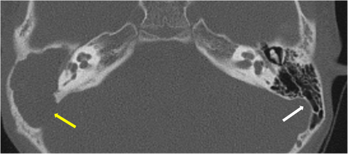 Middle Ear Valsalva With An Eardrum Which Has An Attic Cholesteatoma Youtube